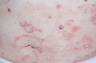 乾癬 皮膚の病気写真画像