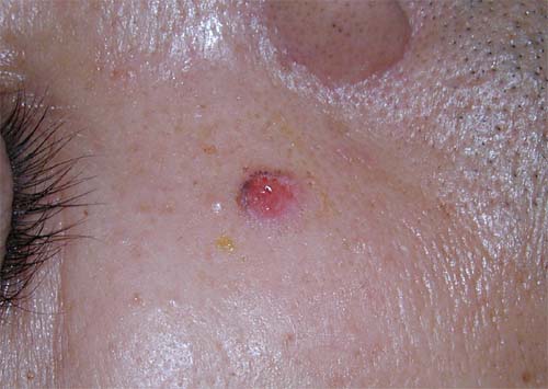 杉並区皮膚科から基底細胞癌写真