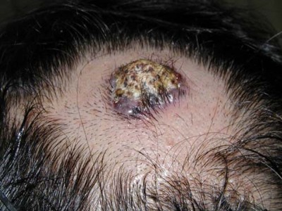杉並区皮膚科から基底細胞癌写真